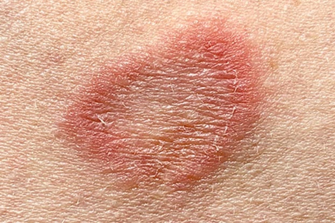 Ringworm (tinea) lesion in close-up — a round, red plaque with a raised, scaly border and a paler center