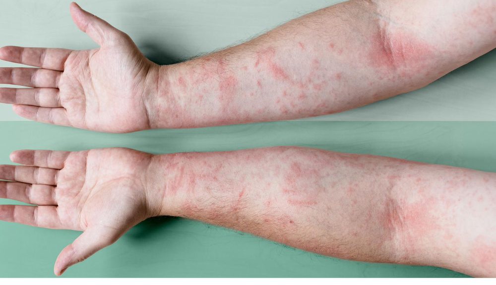 Eczema rash on a forearm — red, blotchy, inflamed patches