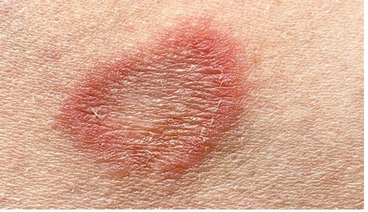 Ringworm (tinea) lesion — a circular, red plaque with a raised, scaly border